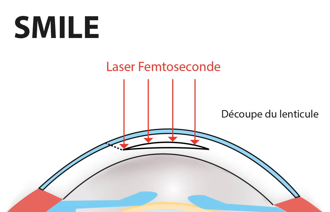 opération SMILE myopie laser